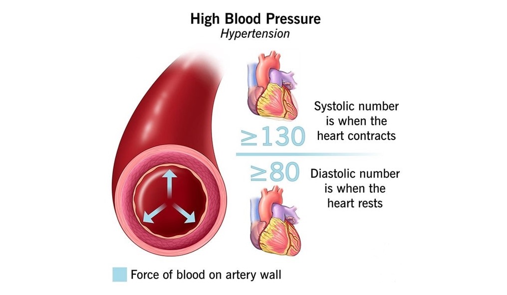 فشار خون بالا